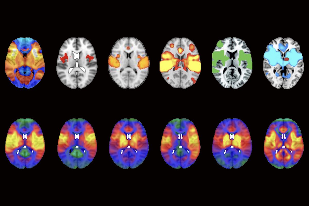boeslab's tweet photo. Is lesion network mapping fatally flawed?  

New Nat. Neurosci article suggests high spatial correlation amongst lesion network maps invalidates the method.  

https://t.co/QTRQXgoNCs

Methodological flaw may upend network mapping tool https://t.co/VdgvSh03Qe https://t.co/uAiSKTZkAc