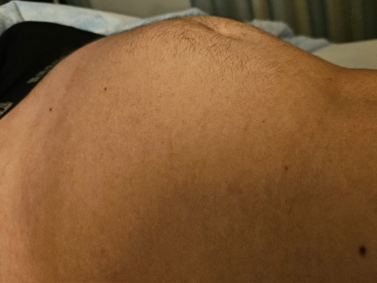 I pushed my bladder to the absolute limit. Chugged tons super fast, zero time to adapt, just relentless stretching.
Started desperate, ended up insanely full, rock-hard &amp; painfully stretched… huge effort, but my bladder handled it like a boss 😏

#omorashi #bladderbulge