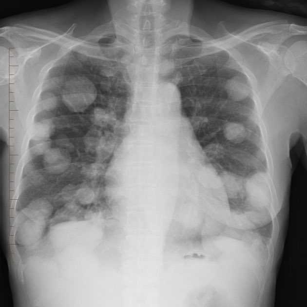 DrNikhilMD's tweet photo. Patient with hematuria and weight loss
Possible Diagnosis?? https://t.co/i1GeRbFlKZ