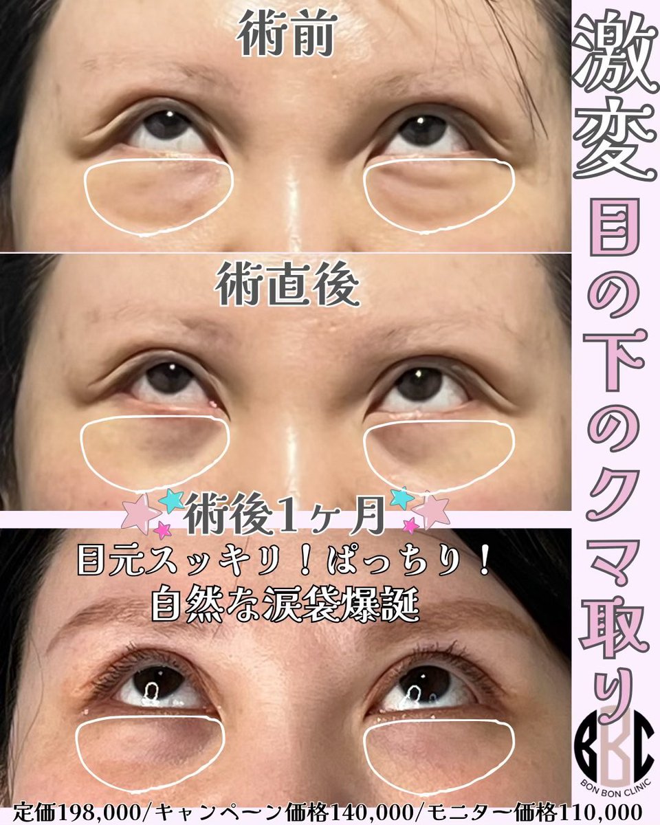 BONBONCLINIC's tweet photo. 銀座院💞はる先生💞
目の下のクマ取り👀✨💉👩🏻‍⚕️💓

印象が激変するお施術でとっても満足度高いお施術です🫶🏻

ヒアル・ボトックス・カベリンも
お得なクーポン🎁LINE限定で配布中🌈

📲今すぐチェックしてねっ💌

☎️03-6263-8261
LINE▶️【@bonbonclinic】で検索🔍

#銀座美容 #bonbonclinic #糸リフト #ヒアルロン酸 #ボトックス