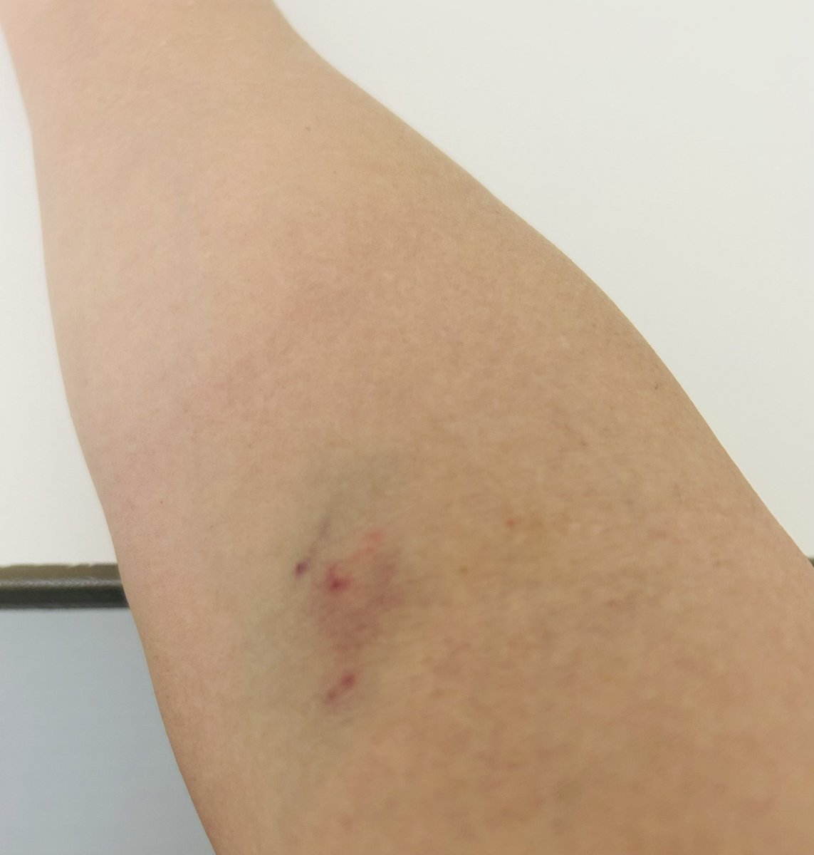 SLAN331's tweet image. 今日は6回採血とお腹に注射💉4回
薬が効きづらい体質なので数値中々下がらない😭
左手血管出ないので全部右😆
ベテラン看護師さんが注射上手いとは限らない！