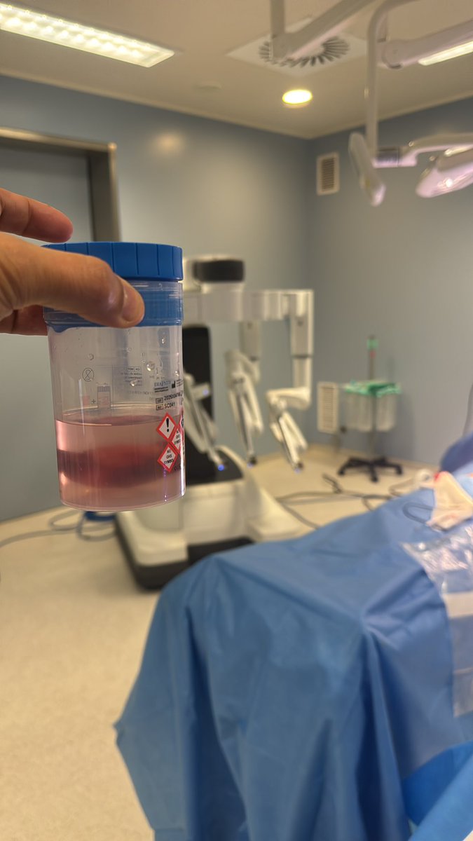 Primera apendicectomía urgente robótica Da Vinci 5 en el Hospital Rey Carlos. <a href="/abexDaVinci/">ABEX Excelencia Robótica</a> <a href="/BelenMansoA/">Belen Manso</a> <a href="/JordiTarasco/">Jordi Tarascó, MD PhD</a> <a href="/CarlosFerrigni/">𝐃𝐫 𝐂𝐚𝐫𝐥𝐨𝐬 𝐉 𝐅𝐞𝐫𝐫𝐢𝐠𝐧𝐢 𝐆</a> <a href="/BalibreaJose/">Jose M. Balibrea MD, PhD, FACS</a> <a href="/AECP_FAECP/">AECP</a>