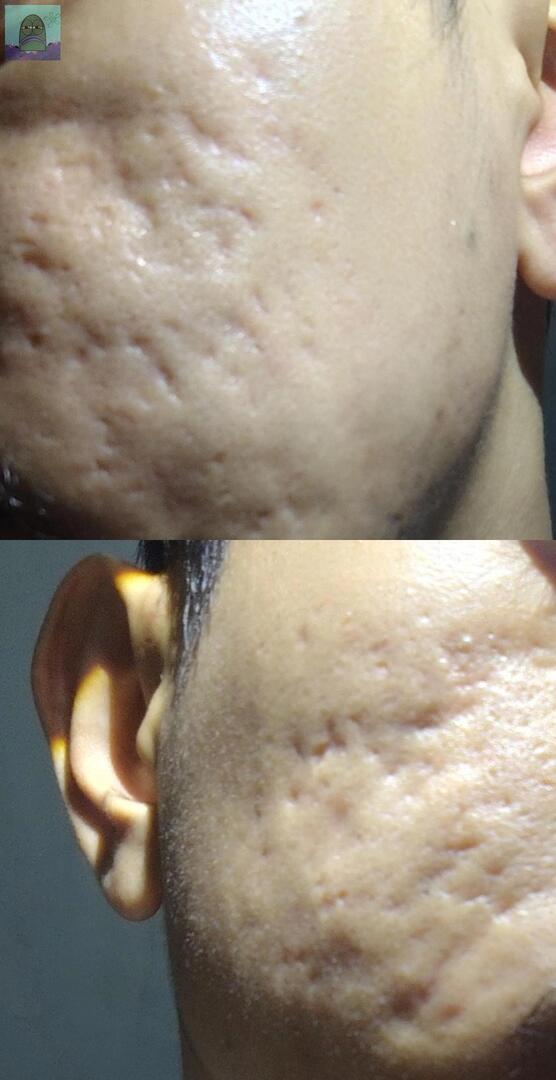 💚 Kira-kira ini jenis bopeng apa ya? Dan treatment apa yang cocok? 
Aku pernah coba subsisi, apakah udh bener? 

Butuh masukannya (krn kalo dokter klinik kan biasanya refer ke treatment yg disediain aja, dan mgkn ada yg yg upsell) 

(Senagaj pakai senter biar jelas)