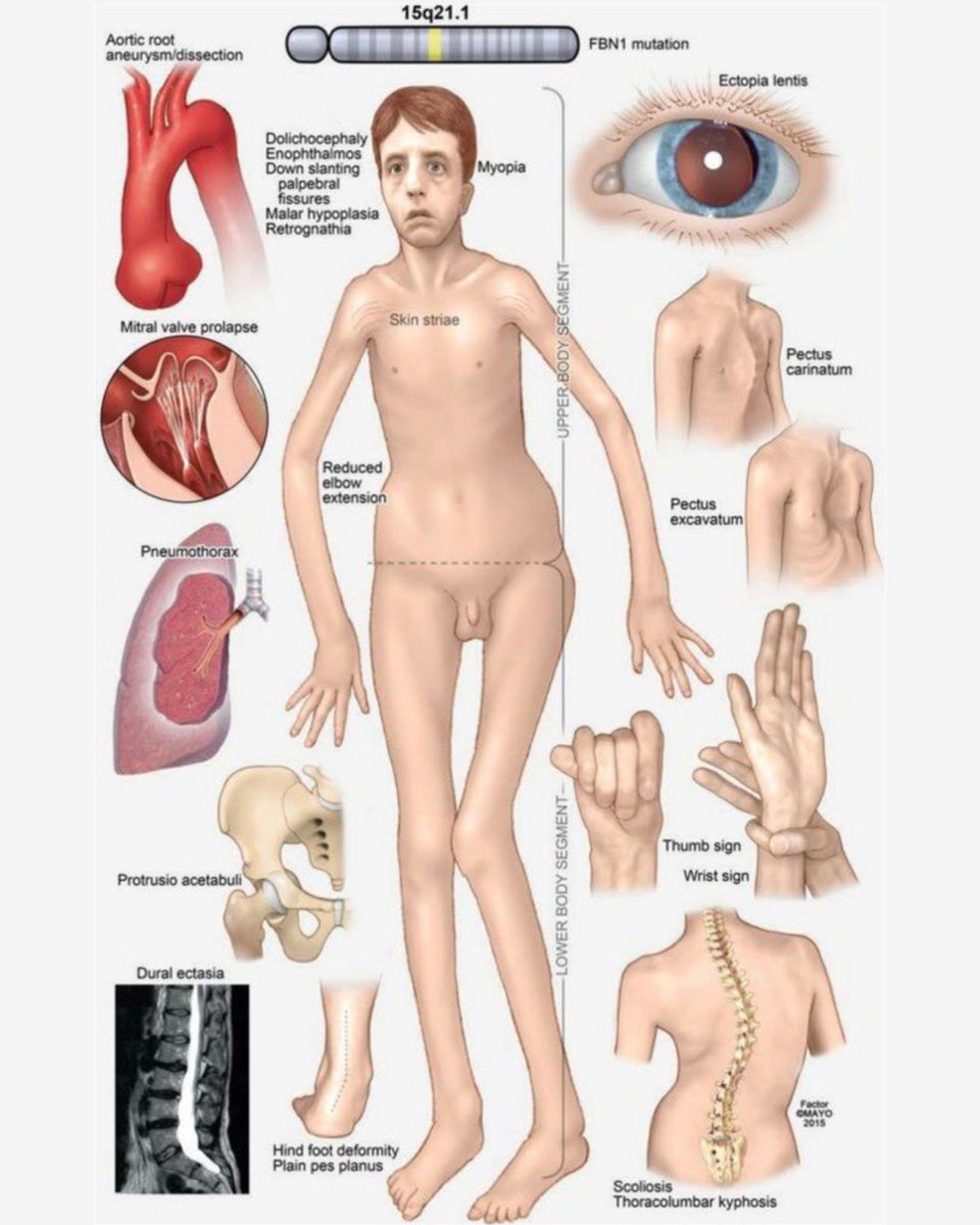 🩻🇫🇷 FLASH - Une étude scientifique révèle la morphologie des gauchistes de centre-ville.