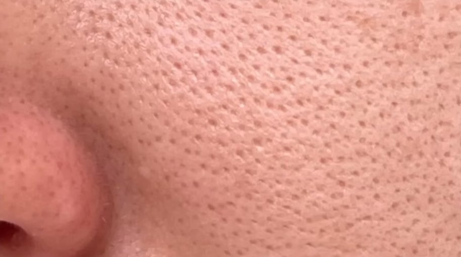 피부 관리 모공편.

넓어진 모공 집에서 어떻게 관리해야하나?
심한 경우 피부과의 도움 받기.

1. 모공을 넓히는 나쁜 습관 (절대 금지) 
손으로 짜기: 피지를 짜는 과정에서 주변 조직에 상처(흉터)가 생겨 '흉터성 모공'이 됩니다. 
이는 모공이 딱딱해져 다시 좁아지지 못하게 만듭니다. 

코팩