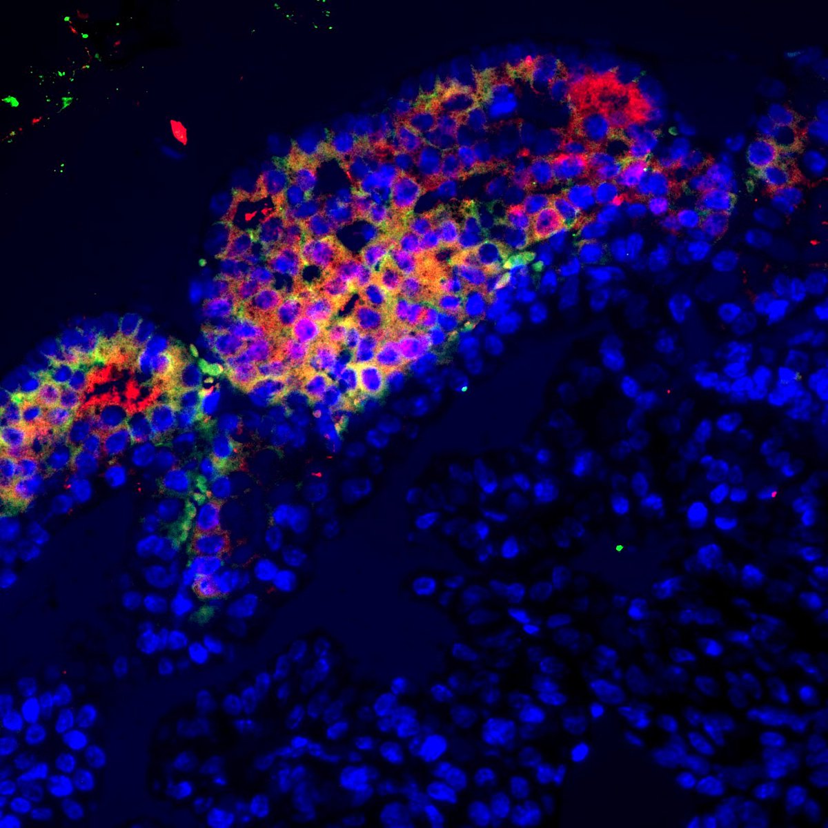 hospitaldelmar's tweet image. Les #cèllulessenescents són determinants en la proliferació tumoral, segons un assaig preclínic d'investigadors de l'@HMar_research i del @VHIO

Obre la porta a una nova combinació de tractaments per frenar els tumors i evitar #metàstasis

#càncerdemama

hospitaldelmar.cat/ca/noticies/vi…
