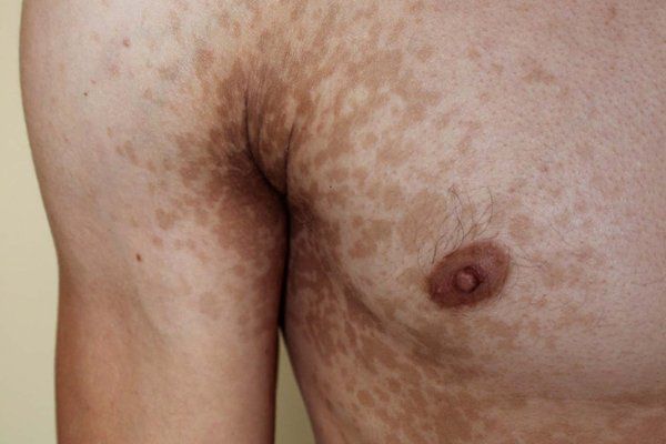 DoctorDhamari's tweet photo. البهق أو البهاق
pityriasis versicolor  
أو ما تسمى بالنخالة المبرقشة.. 
البعض يستخدم سم البريك قد يفيد وقد لا 
لكن الخطة العلاجية هي  .. 

- Ketoral shampoo 
ثلاث مرات بالأسبوع 

- SG ter cream
مرتين باليوم 

- Itraconazol 100mg tab
باليوم حبة لمدة 7 أيام.

#خطة_علاجية. https://t.co/rgg0i5NpvI
