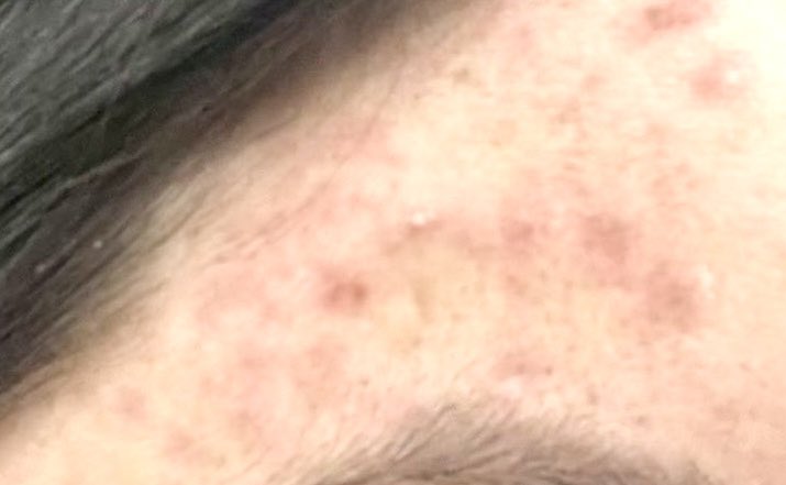 yegubes's tweet image. เริ่มต้นต้นปีด้วยสิว+รอยแดงหายไปแล้ววว กินหมดไป 3 กล่อง (วันละ 2 เม็ด) ดีอะ ดีมากกกกก ไม่ดันสิวออกมาด้วย นี่กดสิวก็คือช่วยรอยจางไปเยอะ skincare ใช้แบบเดิม แต่กินก็ช่วยเพิ่มให้ผิวดีขึ้น