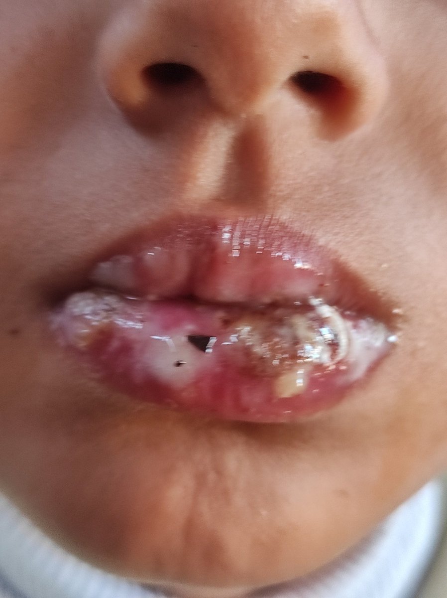 Ibrahimham72401's tweet image. "My daughter is suffering so much 💔
From painful fungal infection in her mouth, along with the flu and a severe cold… the pain never leaves her.
We ask for your help, even if only a little your support could save her and ease this pain 🙏
gofund.me/f8401cef
@Louis_Allday