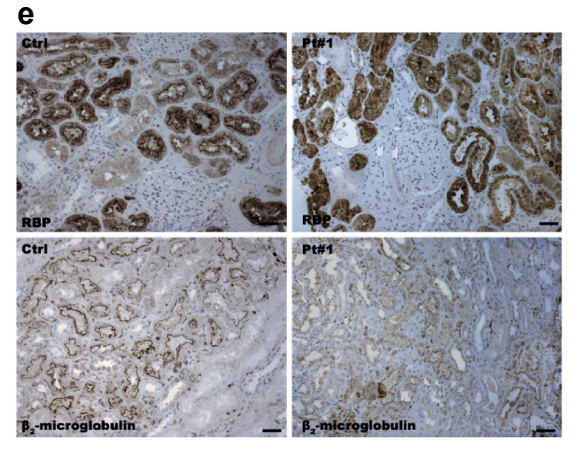 KIReports's tweet photo. Nonprogressive #Nephrotic Range #Proteinuria Because of Indirect #Cubilin Dysfunction
https://t.co/Lm9Lqlqjm3
#KIRNephrologyRounds https://t.co/6dTCIg3pHV