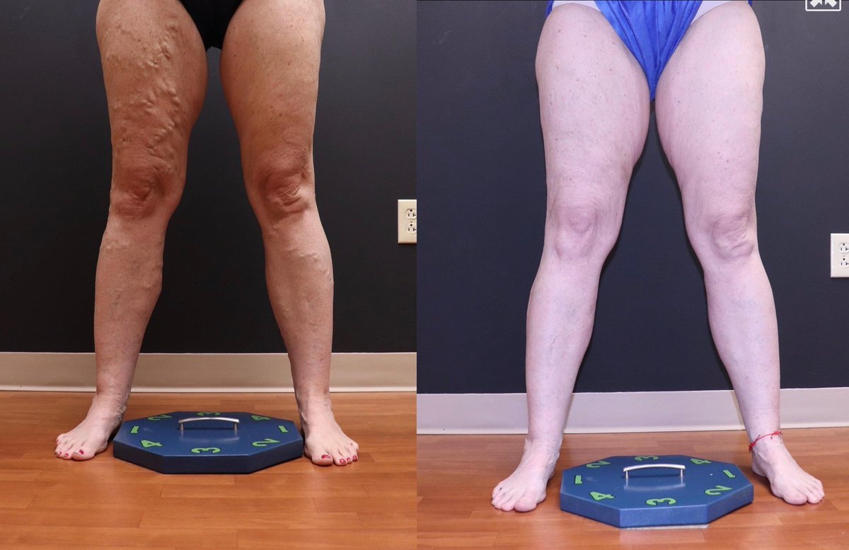 LaserVein's tweet image. ✨ Amazing Transformation Alert! ✨ 
Check out these stunning before &amp;amp; after results from EVLT &amp;amp; 7 ultrasound-guided sclerotherapy treatments over the past 2 years! 😍 
Ready to start your vein journey? Book your consultation today at 636-614-1665! 💙 

#VeinHealth #LLVC