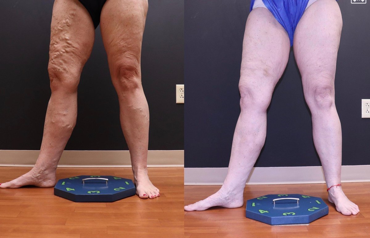 LaserVein's tweet image. ✨ Amazing Transformation Alert! ✨ 
Check out these stunning before &amp;amp; after results from EVLT &amp;amp; 7 ultrasound-guided sclerotherapy treatments over the past 2 years! 😍 
Ready to start your vein journey? Book your consultation today at 636-614-1665! 💙 

#VeinHealth #LLVC