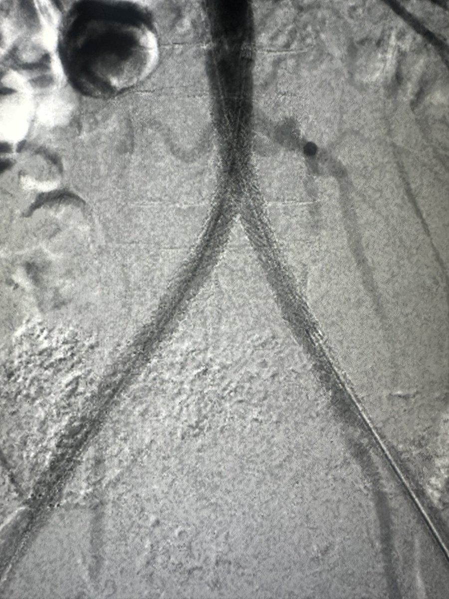 drochohan's tweet image. How do you wipe out collaterals? Kiss them goodbye! #irad #vascular #cardiotwitter @VascularSVS @SIRRFS @SIRspecialists @SIR_ECS