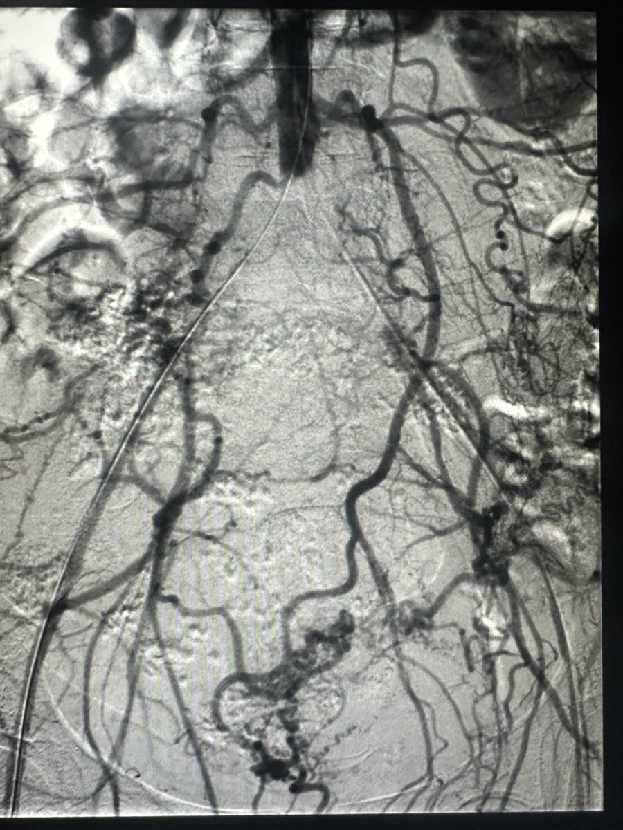 drochohan's tweet image. How do you wipe out collaterals? Kiss them goodbye! #irad #vascular #cardiotwitter @VascularSVS @SIRRFS @SIRspecialists @SIR_ECS