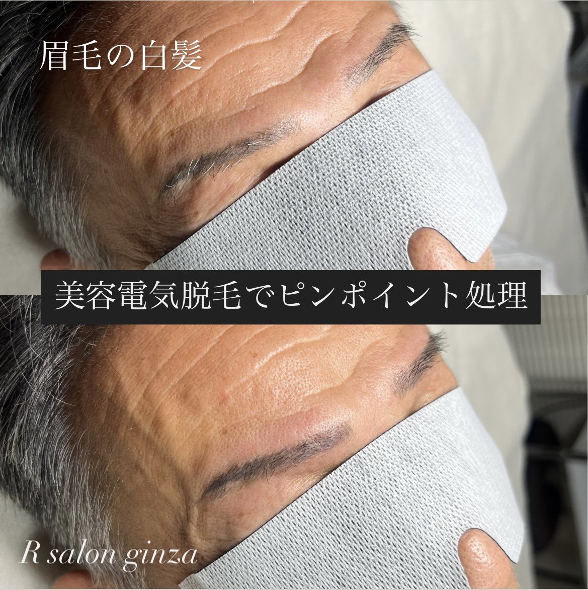 白髪眉毛を、ピンポイント処理しました❗️
処理したいところだけ
綺麗になりました😇

これぞ美容電気脱毛の強み✨

＃眉毛脱毛