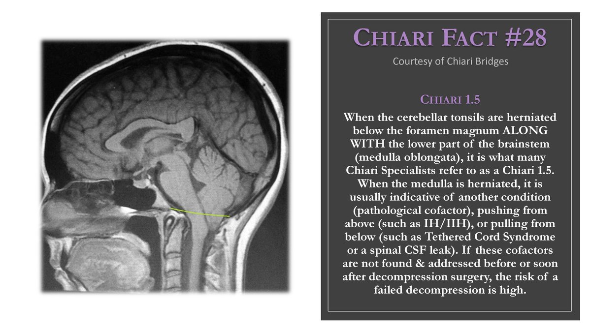 Chiari Bridges (@ChiariBridges) / Posts / X
