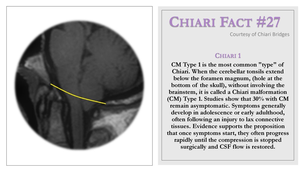 Chiari Bridges (@ChiariBridges) / Posts / X