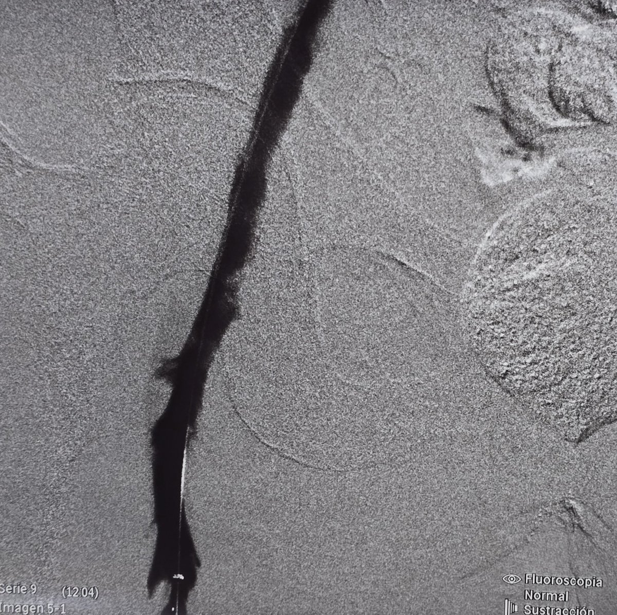 🔵Venous thrombectomy:

Before // After