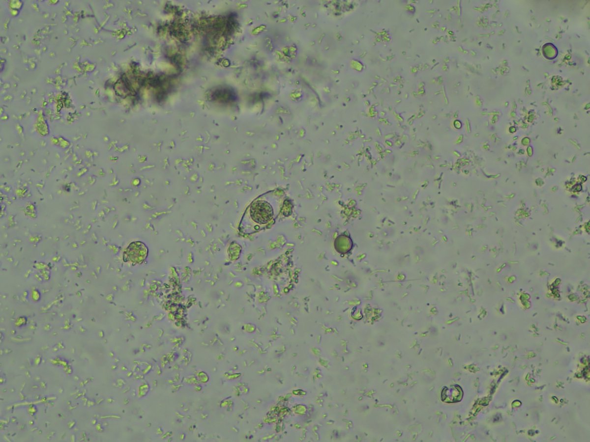 ParasiteGal's tweet image. #Parasite case 786 is up, donated by Dr. Richard Bradbury: found in stool in an HIV positive pt. living in Tanzania. Object measures 25-30 µm.
parasitewonders.blogspot.com/2025/09/case-o… ID?
Answer later this week! #mayopath #pathology #PathBugs