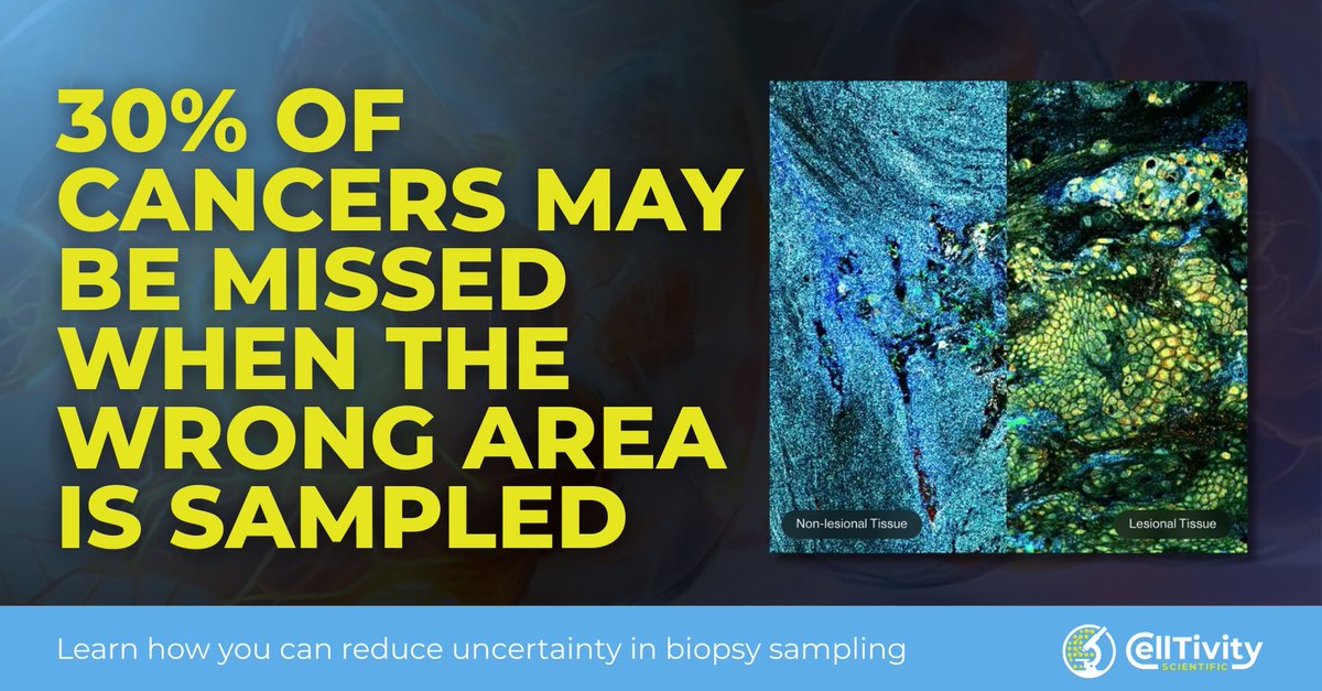 celltivity's tweet image. Up to 30% of cancers may be missed when the wrong area is sampled. This creates delays, repeat procedures, and added anxiety for patients.

Reducing uncertainty in biopsy adequacy is critical to improving confidence.

Learn more: celltivity.com

#lungcancer #medtech