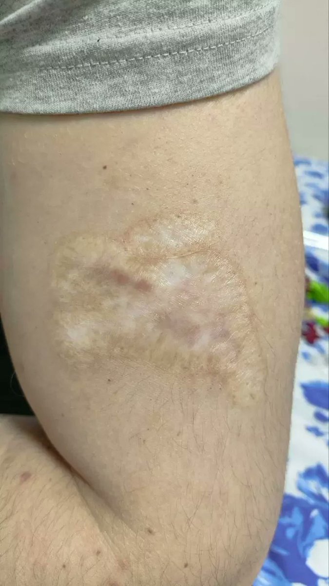 This week, political prisoner Ilya Dubsky was released &amp; forcibly deported after 5 years behind bars. In prison, he was forced to cut off his Pahonia tattoo with a razor blade under threats from the guards.

His scar is a reminder of the torture that the regime's hostages endure.