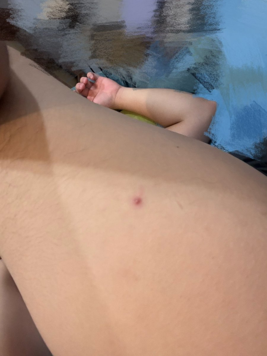 我只是要拍痘痘，原來我大腿後有毛。