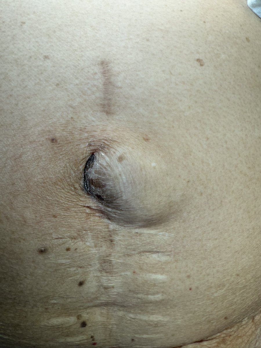 DrJAVazquez's tweet photo. Parece tan inofensiva. El tiempo es intestino. #LaParedImporta #SoMe4Surgery #SoME4IQLatAm #surgicalmentor https://t.co/E3LVwbmLy4