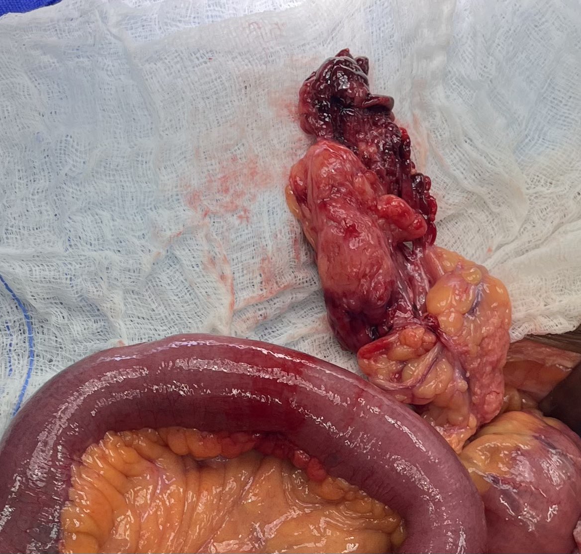 DrJAVazquez's tweet photo. Parece tan inofensiva. El tiempo es intestino. #LaParedImporta #SoMe4Surgery #SoME4IQLatAm #surgicalmentor https://t.co/E3LVwbmLy4