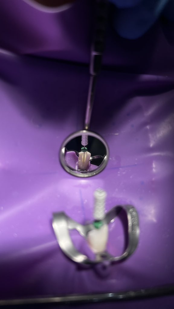 Far04es's tweet photo. First endo obturation ✔️ https://t.co/WOAIqnCNLC