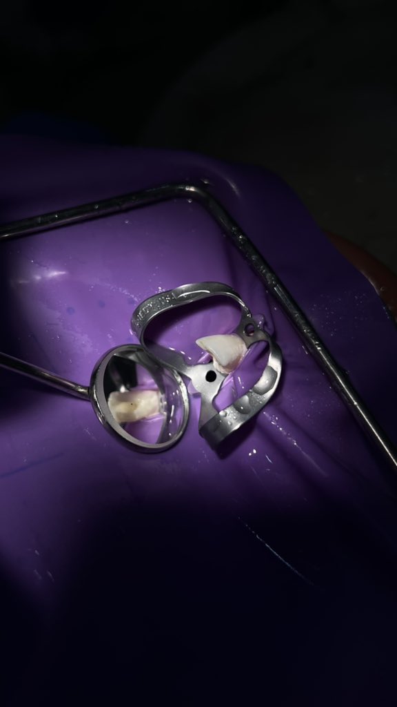 Far04es's tweet photo. First endo obturation ✔️ https://t.co/WOAIqnCNLC
