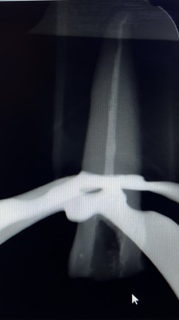 Far04es's tweet photo. First endo obturation ✔️ https://t.co/WOAIqnCNLC
