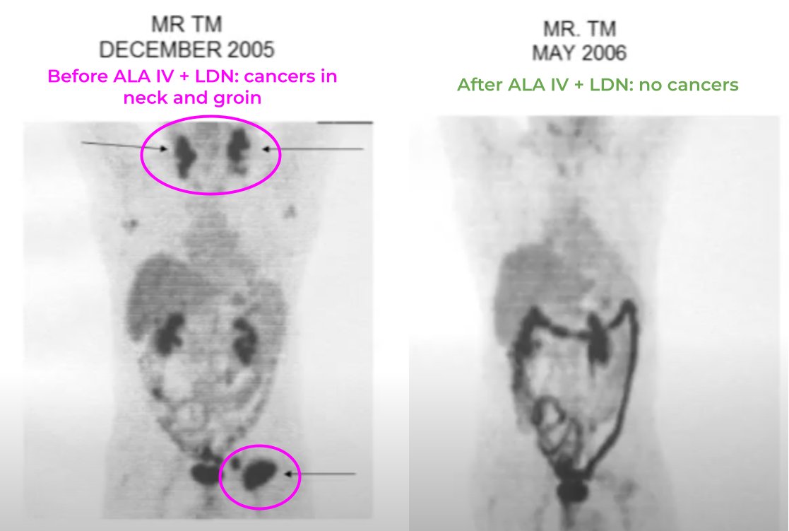 I watched a presentation by Dr. Burton M. Berkson on the topic of “Alpha Lipoic Acid in the Care of Certain Cancers.”

Here my takeaways and commentary:

- Dr. Berkson got a PhD in microbiology
- was told that he thinks too much to be a good doctor
- was told that medical