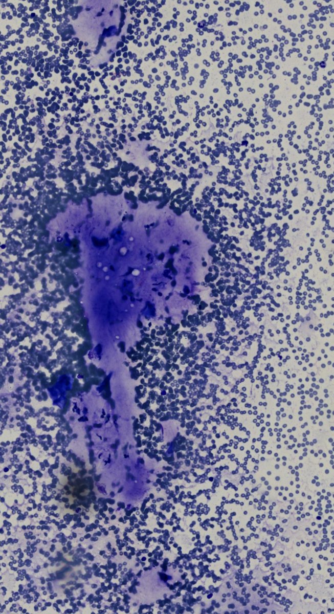 DrCycloPath's tweet photo. 25-year-old with a mobile, oval, 2 cm breast mass. 

What does the FNA show?

#BreastPath #CytoPath #PathTwitter #pathology https://t.co/iVf9whnBnh