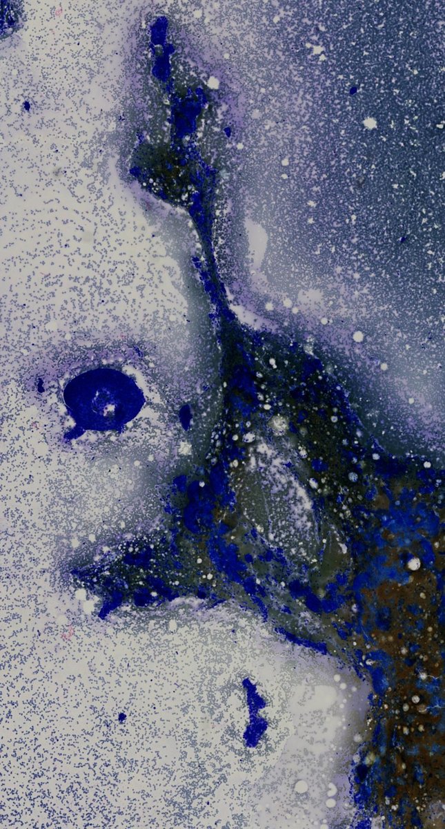 DrCycloPath's tweet photo. 25-year-old with a mobile, oval, 2 cm breast mass. 

What does the FNA show?

#BreastPath #CytoPath #PathTwitter #pathology https://t.co/iVf9whnBnh