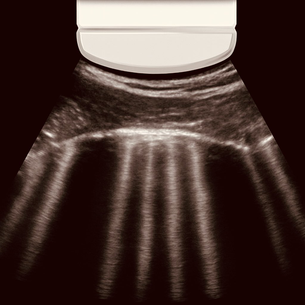 #MedEd #Nephpearls 
IVC and lung #POCUS guided therapy in patients with acute #heartfailure significantly reduced subclinical congestion at discharge and was associated with a lower 90-day rate of heart-failure readmission, unplanned visit for worsening heart failure, or death
