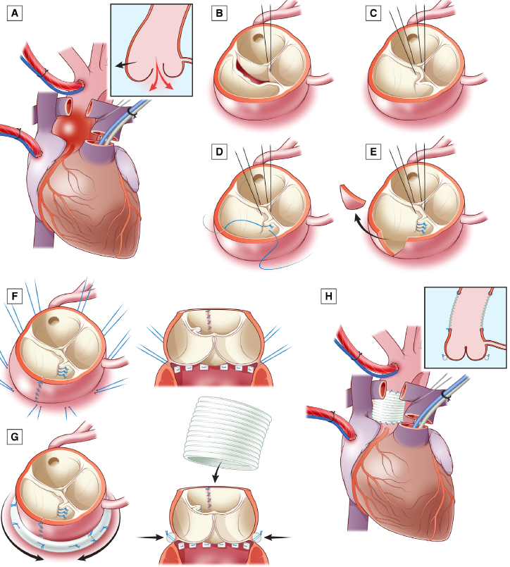 Almost 25% of patients with Taussig-Bing anomaly need aortic valve surgery by 25 years after the arterial switch!
Fricke TA, et al. The arterial switch operation into the third and fourth decades of life. J Thorac Cardiovasc Surg. 2025 Sep 11; PMID: 40945840
