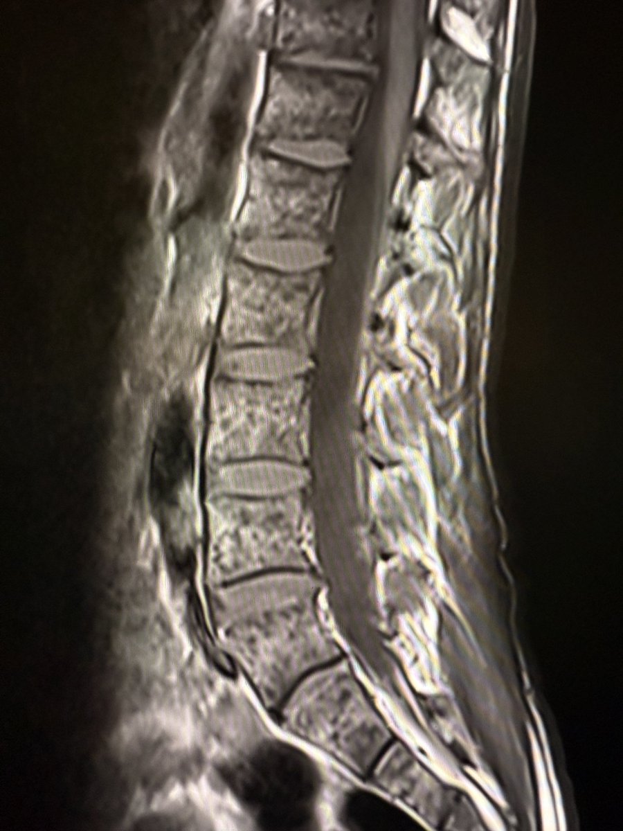 samrad77's tweet image. In treated leukemia, bone marrow tells its own story.

Baseline (left image): There is a diffuse low signal on T1W images, and the vertebral marrow looks uniformly “dark.” The signal is lower than that of the disc.

Six weeks follow-up after therapy (right image): diffuse marrow