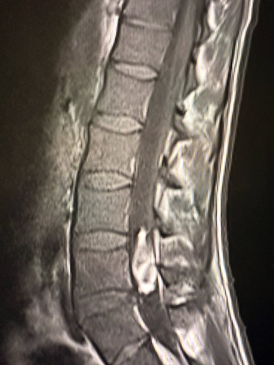 samrad77's tweet image. In treated leukemia, bone marrow tells its own story.

Baseline (left image): There is a diffuse low signal on T1W images, and the vertebral marrow looks uniformly “dark.” The signal is lower than that of the disc.

Six weeks follow-up after therapy (right image): diffuse marrow