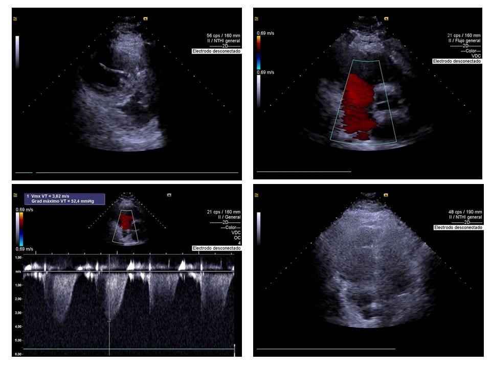🏥#Casoclinico 👨‍🦱41 años 
 Tromboembolismo masivo en pulmón derecho ⬇️

El tromboembolismo pulmonar es una grave enfermedad que puede resultar mortal. Al ser un proceso agudo, genera de forma súbita disnea intensa, dolor torácico y malestar profundo.
grupocorpal.com/tromboembolism…