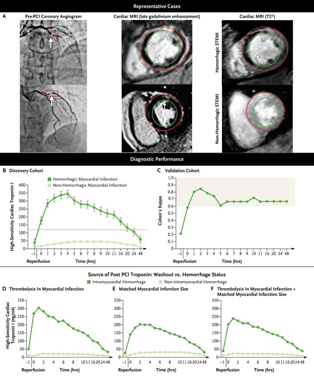 NEJMEvidence's tweet photo. “Post-PCI troponin kinetics may have the potential to diagnose hemorrhagic MI, which was associated with in-hospital mortality.” 🏥 https://t.co/JMaXgmRkvb 

@KeyurVoraMD @AnkurKalraMD @rameshsi3 @rohandkumar1 https://t.co/5Qi2mLS0Z2