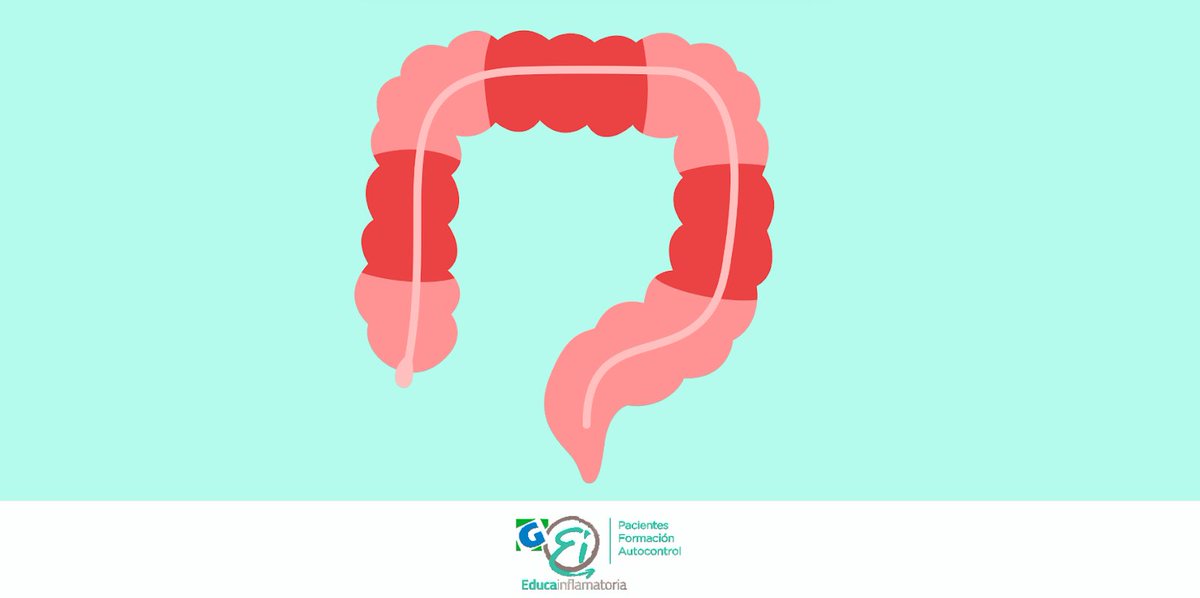 EntrenaEII's tweet photo. La enfermedad de #Crohn puede afectar a cualquier parte del tubo digestivo, aunque la localización alta (estómago, duodeno, yeyuno o íleon proximal) es poco frecuente: se da sólo en un 0,5–10 % de los casos. https://t.co/7H7ZKFuubP