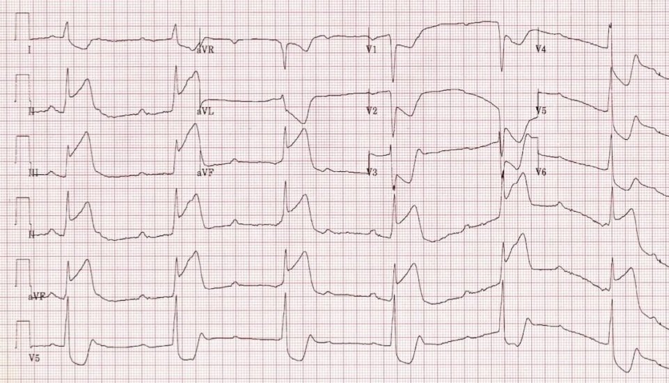 Ecg Rhythms Complete Heart Block With Junctional Escape Rhythm