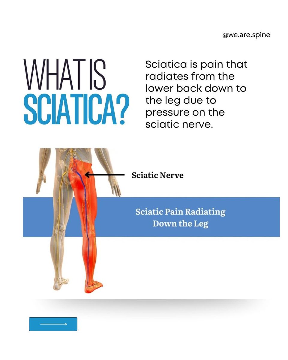 wearespine's tweet image. 🌙 Why Sciatica Steals Your Sleep
Night pain gets worse because:
🛏️ Nerve pressure rises lying down
🔄 Less movement = stiffness
🔥 Inflammation peaks at night

✅ Try tonight: knee pillow, hamstring stretch, child’s pose.

#wearespine #stretch #SmoothAndPowerful #Mumbai #Monday