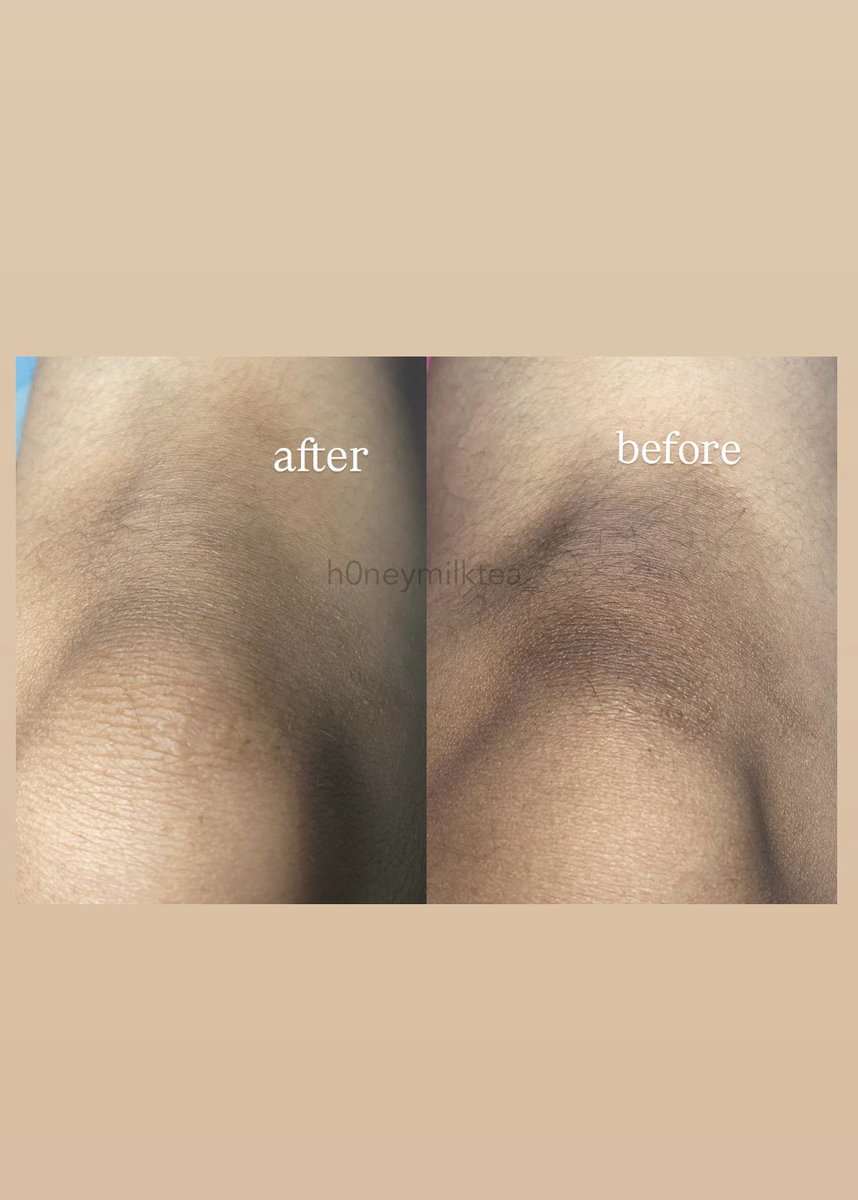 local brand never goes wrong: TERATU🏆

no more selangkangan hitam, tumit hitam, ketiak hitam bisa cerah &amp; balik ke warna semula✅