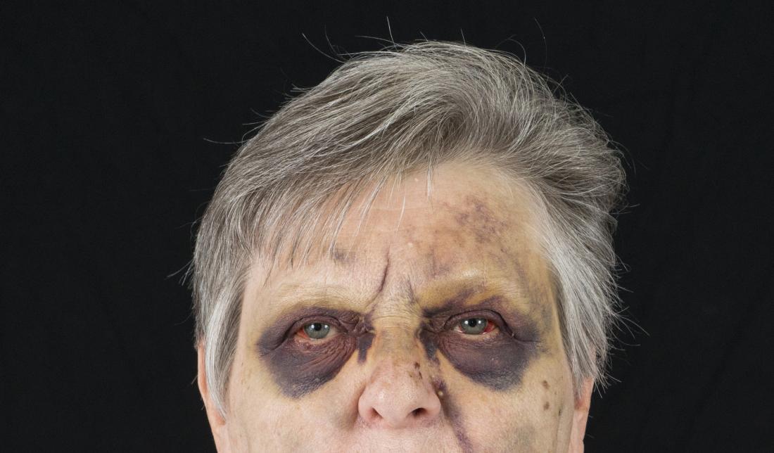 Un hematoma bajo los ojos que parece un antifaz de mapache puede ser la primera pista de una fractura craneal, una leucemia o un trastorno de la coagulación… pero también un drama molecular invisible, la amiloidosis y te lo cuento en este #hilo_sc