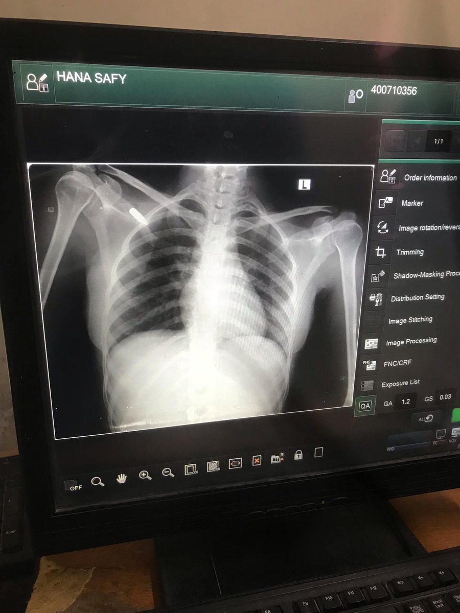 Hnajhad43695's tweet image. 💔 To stay alive, I urgently need surgery to remove a bullet from my chest.
💉 The cost is $700 — I have no way to afford it.
🙏 Please, save an innocent soul… for the sake of my children.
#SaveMyLife #HelpNeeded #DonateToSave