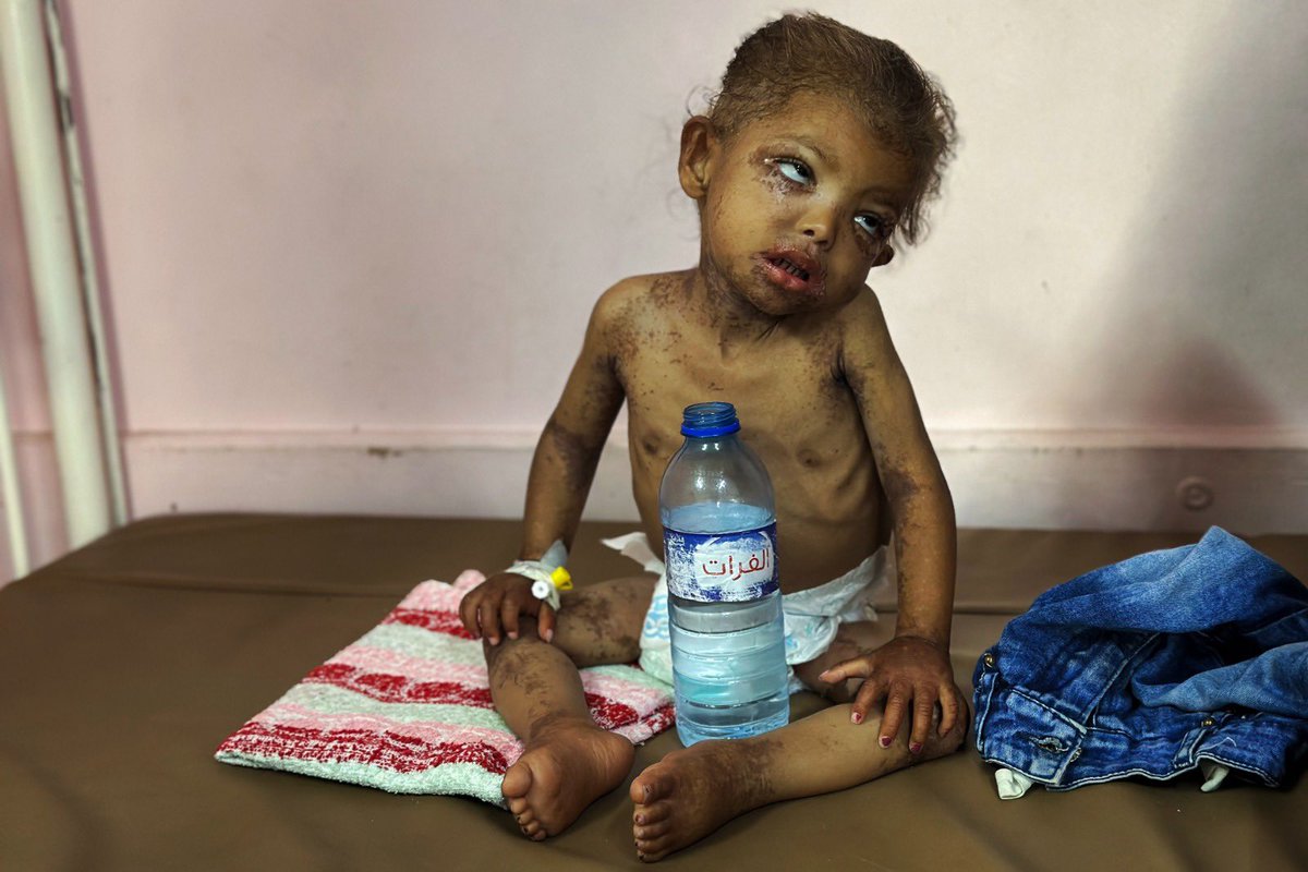 AbujomaaGaza's tweet image. MoH
Gaza hospitals are swamped with large numbers of malnourished people including children, adults and elderlies