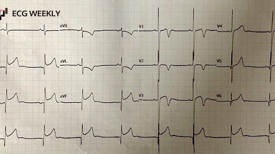 A 16 yo male is referred to the emergency department from a primary care clinic with concern for STEMI. He has no known past medical history. At the clinic, he reported nonspecific chest pain, but upon arrival to the ED he is asymptomatic......ecgweekly.com/weekly-workout…