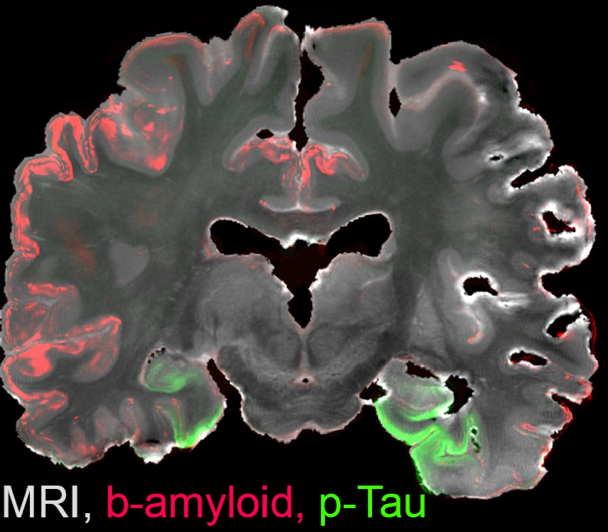brainpathol's tweet image. A unified 3D reconstruction of microscopy and MRI in a brain showing Alzheimer&apos;s disease-related neuropathology
onlinelibrary.wiley.com/doi/10.1111/bp…