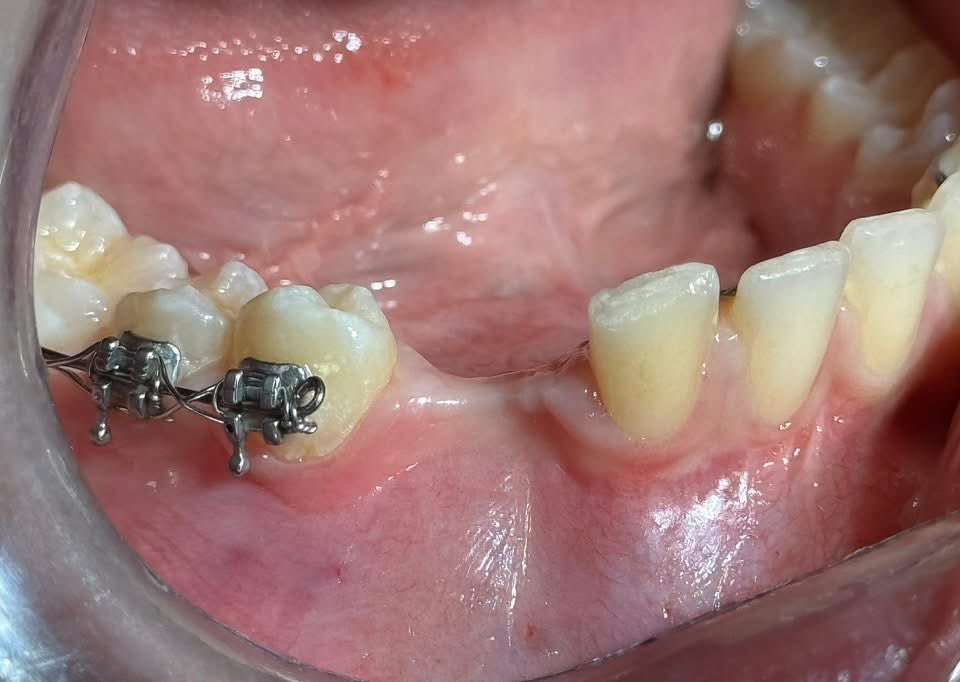 aboutDent's tweet photo. Very interesting case!!!

“Autotransplantation of an impacted canine.

The tooth was extracted and transplanted into its natural position.

A surgical socket was created to accommodate the tooth. After an initial healing period of a few weeks, the transplanted tooth reattached to the alveolar bone, also allowing orthodontic treatment.

The latest follow-up (photo and X-ray) is at 2.5 years.”

What do you think 🤔 

1️⃣

#AboutDent